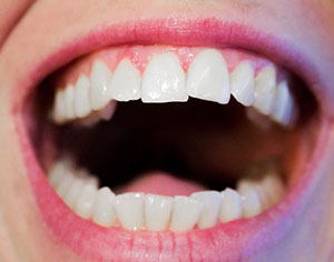 כל מה שרציתם לדעת על הלבנת שיניים ולא היה לכם את מי לשאול